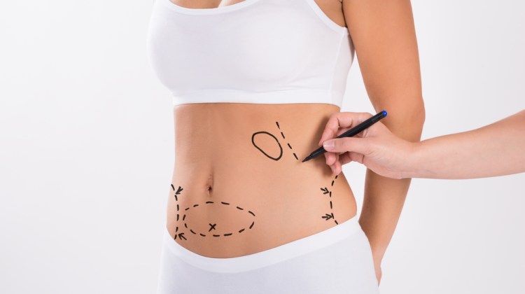 Are You Thinking About Lipo for Weight Loss?